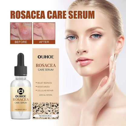 30ml Rosacea Cure Serum -