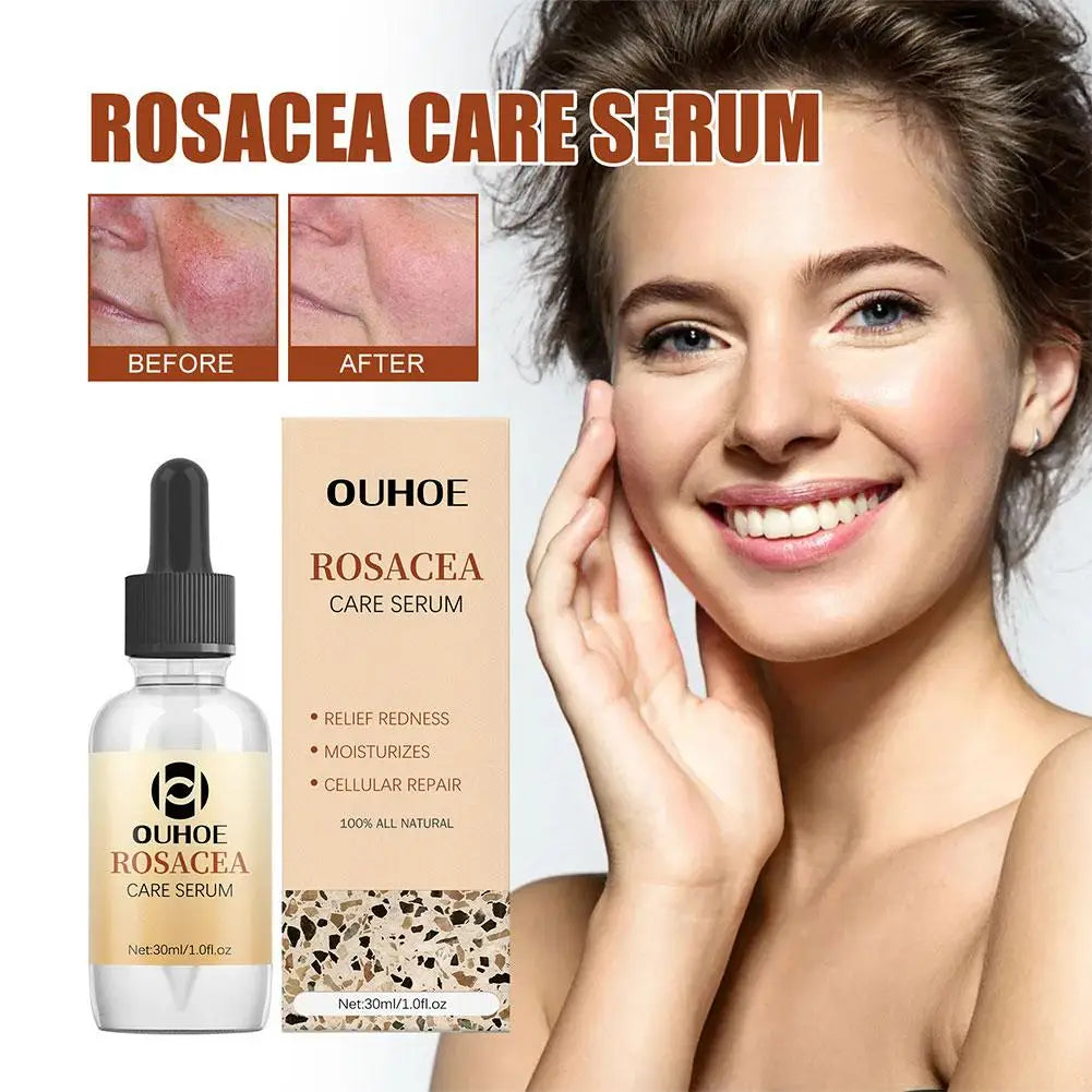 30ml Rosacea Cure Serum -